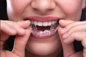 SureSmile® - Affordable Clear Braces